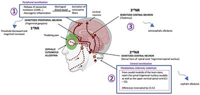 Cutaneous Allodynia in Migraine: A Narrative Review